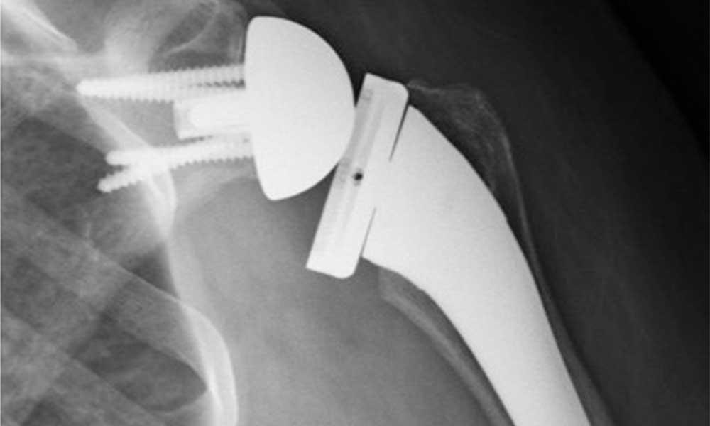 of Reverse Shoulder Replacement Surgery Work Injury