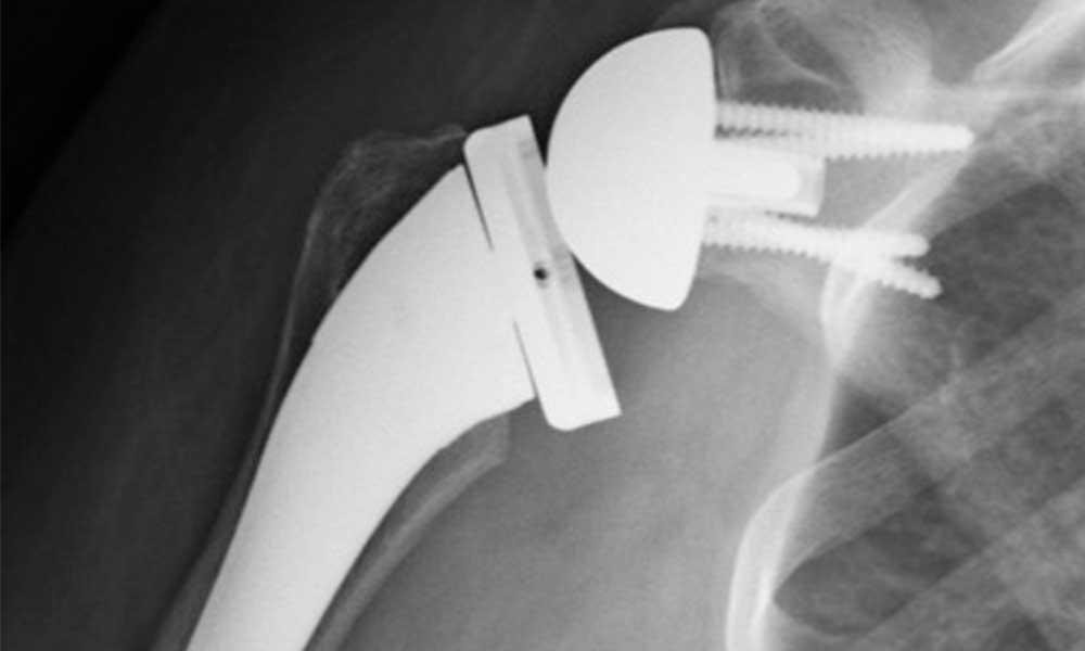 How to Decrease Infection After Shoulder Replacement Surgery